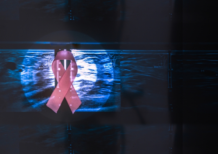 Impacto do resultado do teste de 21 genes na decisão de tratamento para câncer de mama inicial em um Hospital Público no Brasil